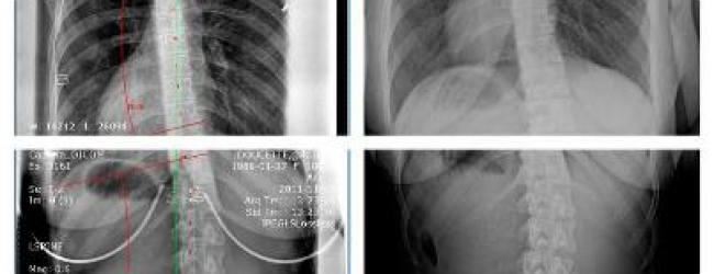 Un interessante caso studio su Rolfing e Scoliosi Un interessante caso studio su Rolfing e Scoliosi